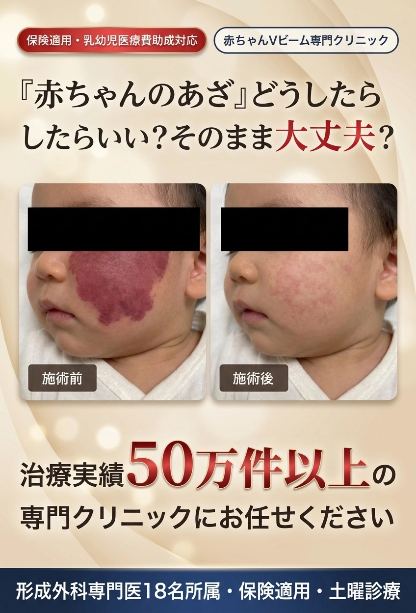 赤ちゃんのあざ どうしたらいい？そのまま大丈夫？ 治療実績50万件以上の専門クリニックにお任せください 保険適用・乳幼児医療費助成対応 形成外科専門医18名所属・保険適用・土曜診療