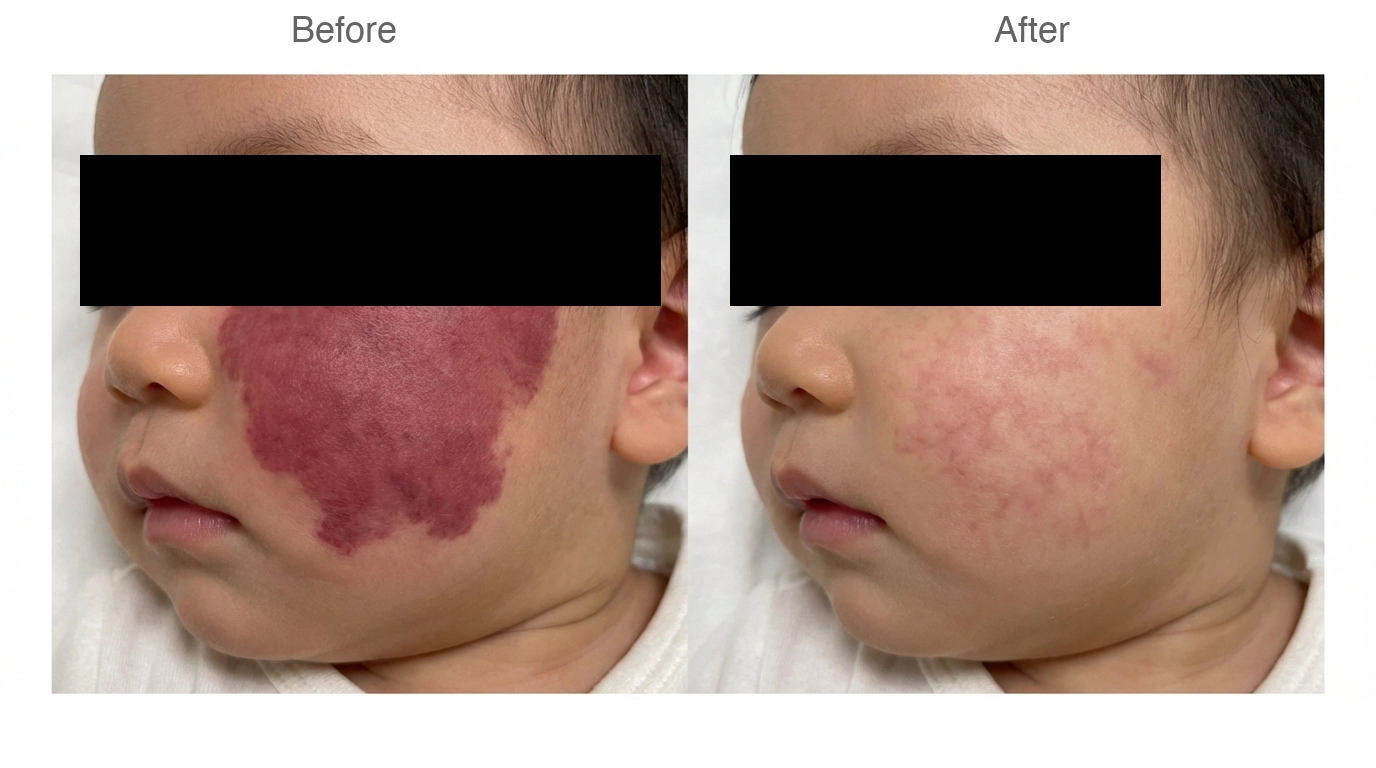 ポートワイン母斑（単純性血管腫）の症例 施術前と施術後