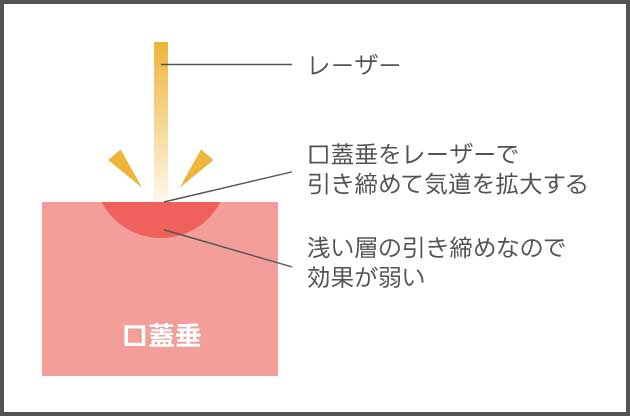 口蓋垂をレーザーで引き締めて気道を拡大する浅い層の引き締めなので効果が弱い