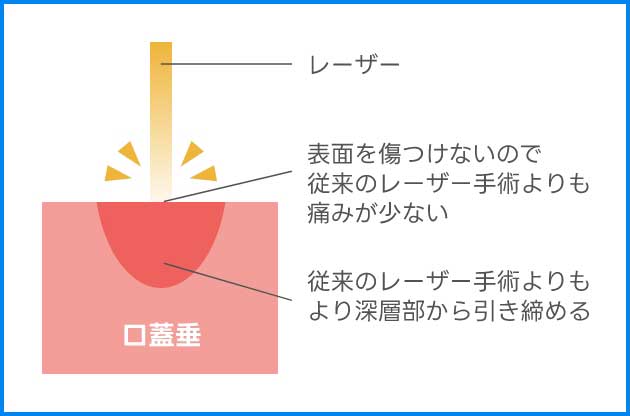 口蓋垂をレーザーで引き締めて気道を拡大する浅い層の引き締めなので効果が弱い