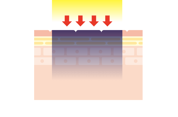 レーザーを照射